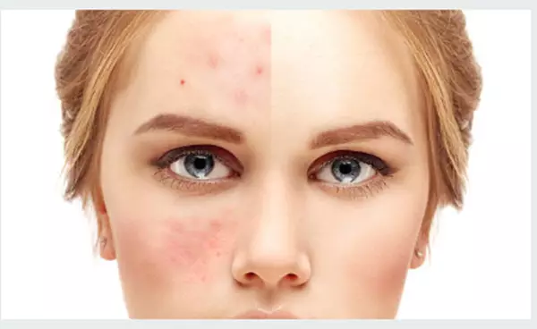 Kit Completo para Acne