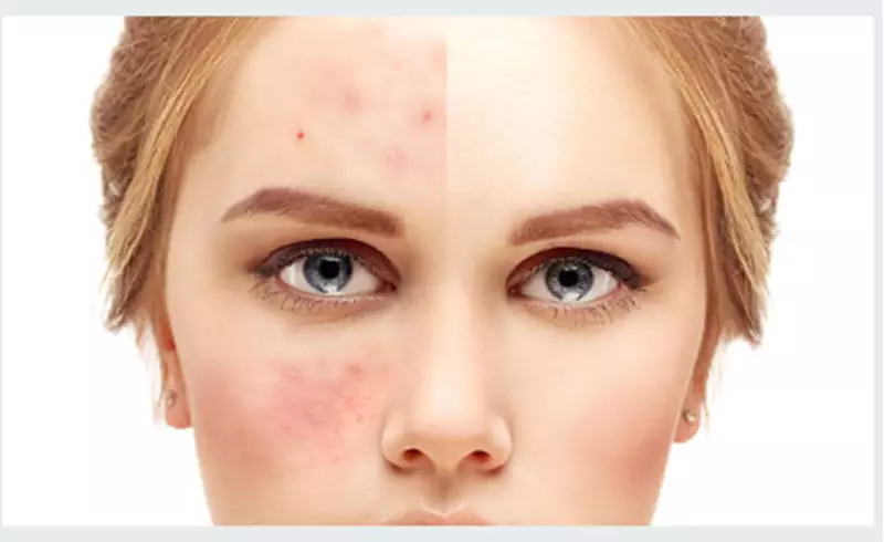 Kit Completo para Acne